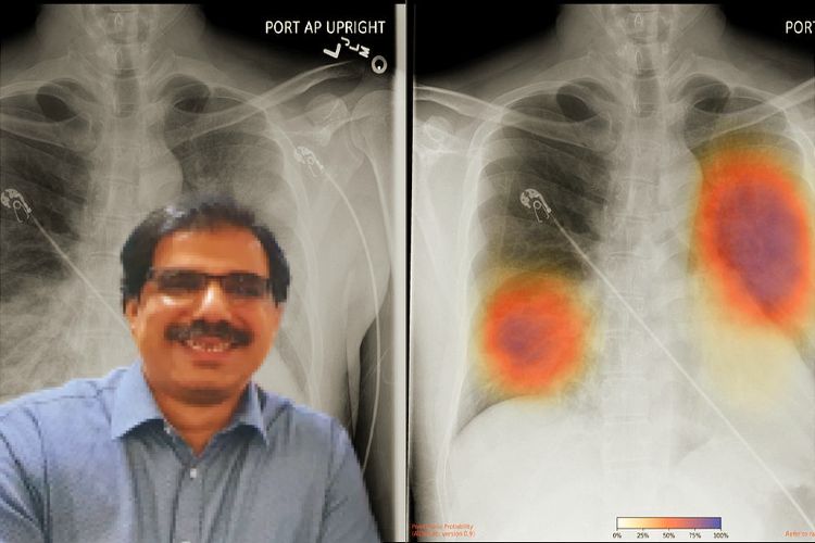 اب ایکسرے سے پکڑا جائے گا کورونا : پروفیسر رمضان کا کارنامہ